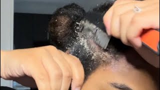 Dandruff Scratching|ASMR