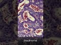 Insulinoma - Pathology #shorts