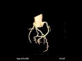 3D Coronary arteries on a Cardiac CT scan 3D Coronary arteries on a Cardiac CT scan