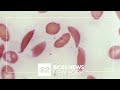 Expert joins CBS New York to discuss new sickle cell treatment