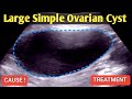 Large Simple Ovarian Cyst - Ultrasound