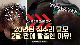 20년된 정수리탈모 2개월 만에 탈출한 이유!