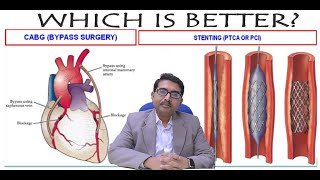 অ্যান্জিওপ্লাস্টি না কি বাইপাস সার্জারি? কোনটা বেশী ভালো?  Angioplasty or Bypass? Which is better?