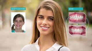 Carriere patients Video showing before and after braces