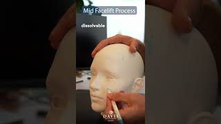 How does a mid facelift work? 🤔