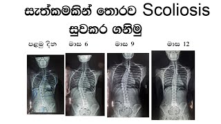 How to correct scoliosis without surgery.