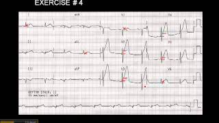 12-15 Lead ECG:  Exercise # 4