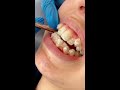 invisalign Şeffaf plak sadece basİt ÇapraŞikliklari mi ÇÖzer