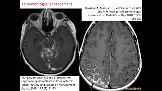 30. Meningeal enhancement; pachymeninges, leptomeninges, subarachnoid lymphatic like membrane (SLYM)