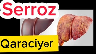 QARACİYƏR  SİRROZU Nədir?SƏBƏBLƏR və Ağırlaşmaları.