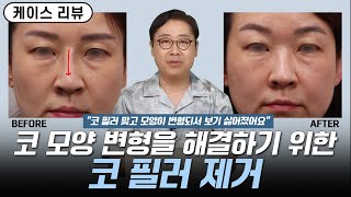 [코필러 제거 케이스 리뷰] 코 모양 변형을 해결하기 위한 코 필러 제거