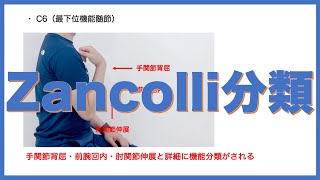 Zancolliの上肢機能分類｜評価法を覚えるコツを教えます！