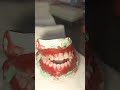 braces on teeth dentallife smiledesigndental doctor motivation dentalprosthesis