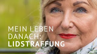 Lidstraffung: Ich hätte es schon vor 10 Jahren machen sollen