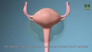 IVF Treatment & Procedures Explained - IVF Process: Getting Started