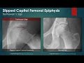 Slipped Capital Femoral Epiphysis: Plain Radiography