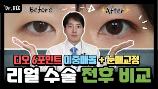 [ENG/전후사진] 자연스러운 인라인 쌍꺼풀! 리얼 수술 전후 비교 👀