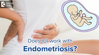How successful is IUI with endometriosis? - Dr. Rashmi Yogish | Doctors' Circle