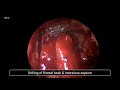 revision endoscopic frontal sinus surgery. modified lothrop procedure. draf 3.