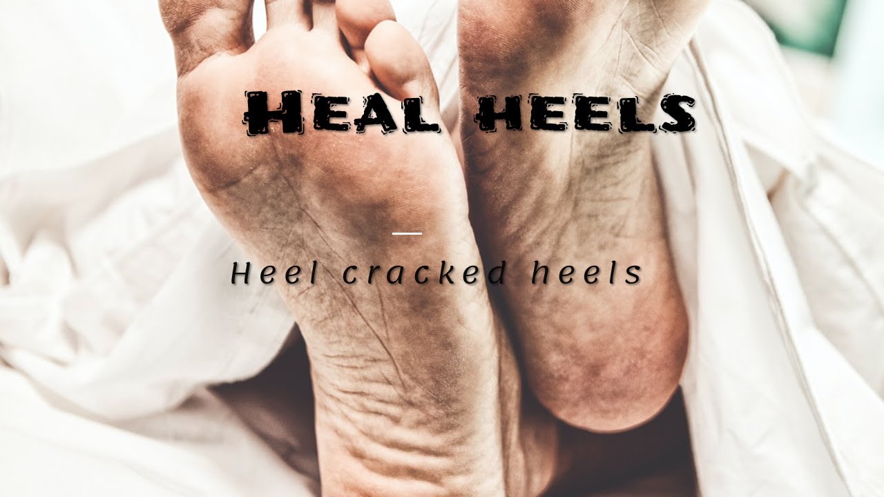 Heal Cracked Heels At Home - YouTube