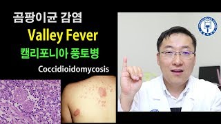 감기가 오래가나요?    Valley Fever를 의심해봐야 할수도 있습니다.