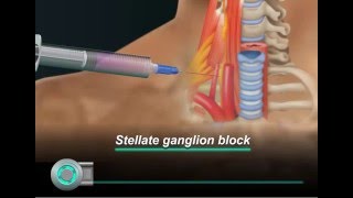 stellate ganglion block