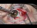 simulated surgery strabismus surgery resection techniques