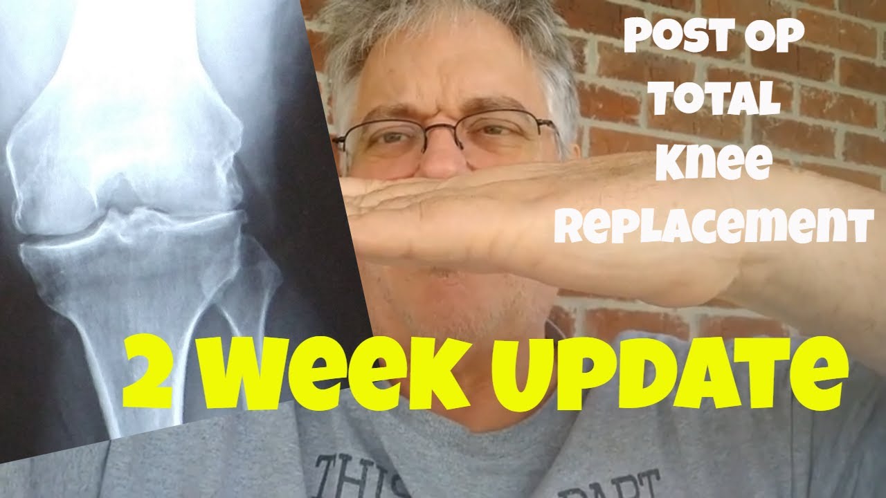 2 Weeks After Total Knee Replacement Surgery Update - YouTube