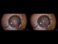 3D Surgery: Phacoemulsification in a Mature Cataract: Dr. Larry Benjamin