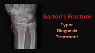 Barton's fracture | Forearm fracture | Distal radius fracture | Intra articular fracture