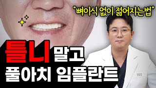 임플란트로 10년 젋어지는법. 최소 식립 풀아치 임플란트 진짜 후기 (전체 임플란트 vs 하이브리드 임플란트)