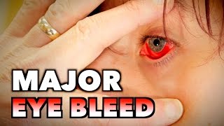 MAJOR EYE BLEED + (Possible Mono, Spleen Exam, \u0026 Blood Draw) | Dr. Paul