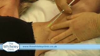 Armpit sweating (axillary hyperhidrosis) treated with Botulinum Toxin A
