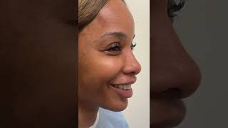 BARBIE NOSE TRANSFORMATION | Revision Rhino Ethnic Nose | Results pt. 2 #rhinoplasty #plasticsurgery