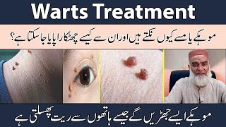 Warts Treatment In Urdu/Hindi | Moko Ka Ilaj | Mason Ka Ilaj |Skin Problem |Al-Razaqi Health Recover