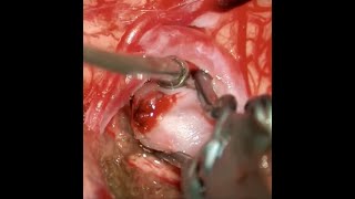 Microsurgical Clipping of a Large Unruptured MCA Bifurcation Aneurysm