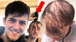 BALDING At 22 - I've Totally Had Enough Of Going BALD
