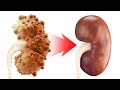 The REAL Cause of Chronic Kidney Disease and Polycystic Kidney Disease