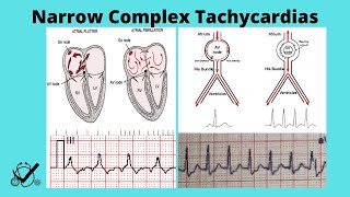 Narrow Complex Tachycardias (A-fib RVR, Atrial Flutter, SVT, Sinus Tach) and Treatments