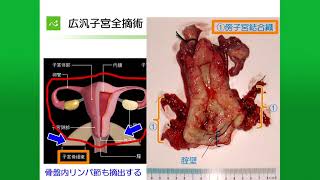 子宮頸がんの治療