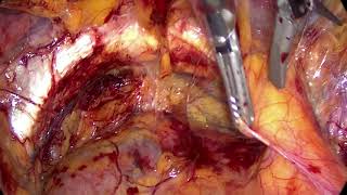 Hernioplastia inguinal bilateral TEP  Dr.FedericoGrasa