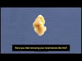 tonsil stone removal how to remove tonsil stones at home