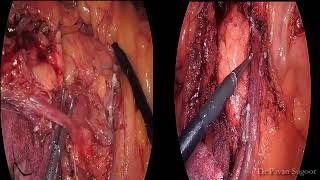 Laparoscopic CME-CVL : SMV First Bottom up appoach