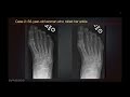 Sports Medicine Case 20: 24-year-old male: An Unusual Presentation of Foot Pain in a Soccer Player