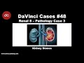 Kidney Stones Case [#DaVinciCases Renal 8 - Pathology Case 3]