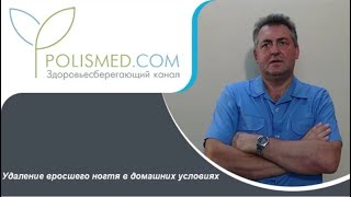 Удаление вросшего ногтя в домашних условиях: частичное и полное удаление