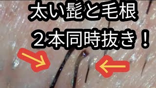 極太ひげ２本同時抜き！tweezers