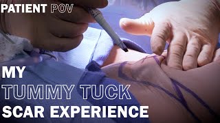 My Tummy Tuck Scar Experience - Dr. Rolando Morales M.D. FACS FICS