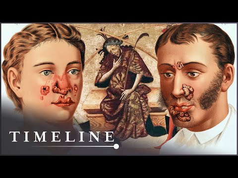 Syphilis Epidemic of 1495: The Deadly Disease That Swept Europe The Timeline of the Syphilis Enigma