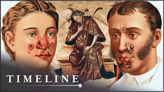 1495 Syphilis Outbreak: The Deadly Disease That Swept Across Europe | The Syphil